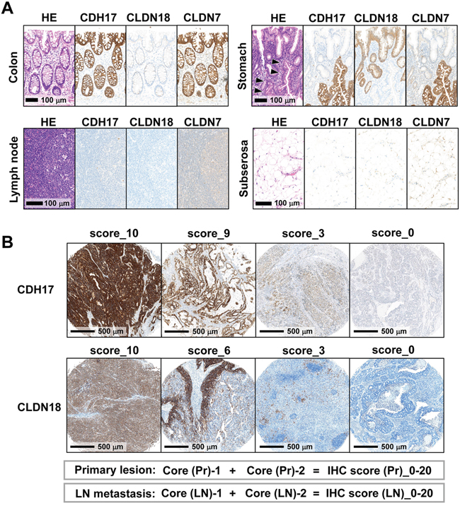 Immunohistochemical analysis of normal tissue and TMAs of gastric cancer tissue.