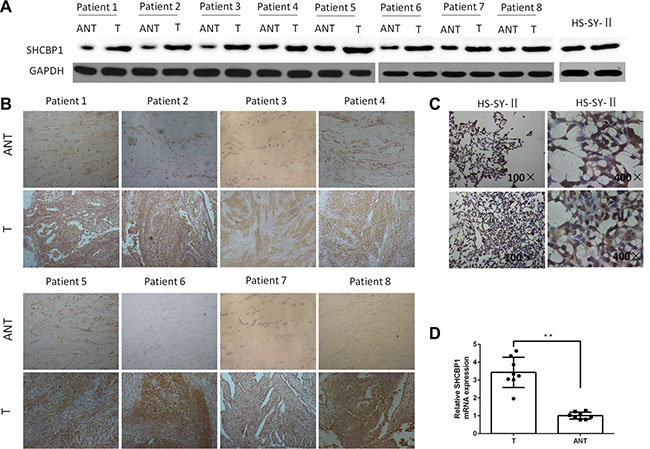 SHCBP1 expression is overexpressed in SS cell line and SS tissues.
