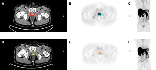 Pre- and posttherapeutic imaging example of a 66 year old patient with locally advanced prostate cancer (PSA before neoadjuvant therapy 12.63 ng/ml, Gleason score 6) before (A&#x2013;C) and after neoadjuvant therapy (D&#x2013;F).