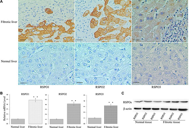 RSPOs (RSPO1, RSPO2, and RSPO3) were overexpressed in human fibrotic liver tissues.
