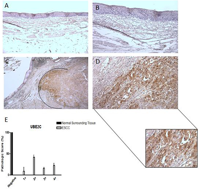 UBE2C protein expression pattern in esophageal squamous cell carcinomas (ESCC).