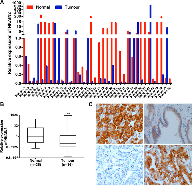 NKAIN2 expression is commonly decreased in prostate cancer.