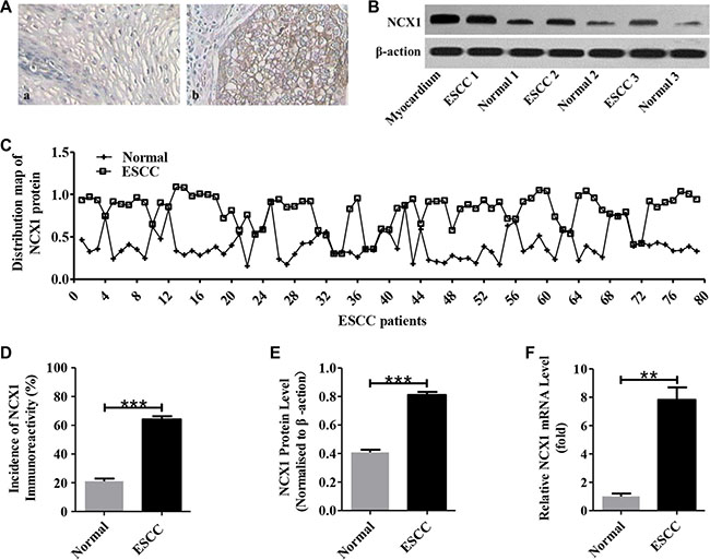 Enhanced expression of NCX1 in primary human ESCC tissues compared with noncancerous normal tissues.