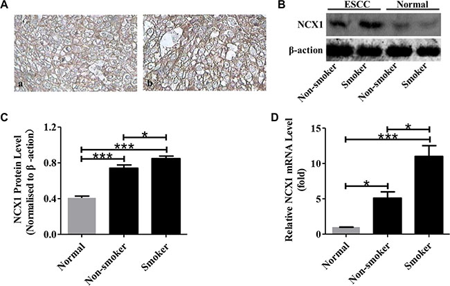 Relationship between NCX1 expression and smoking status of ESCC patients.