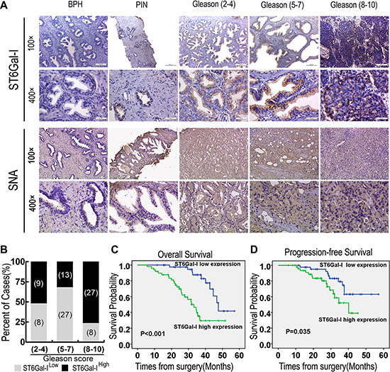 ST6Gal-I upregulation in PCa tissues was correlated with patient prognosis.