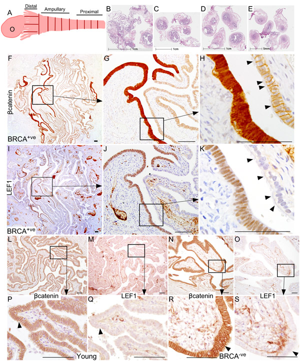 Hyperactive Wnt/&#x3b2;catenin signalling is present in the Fallopian tube epithelium of