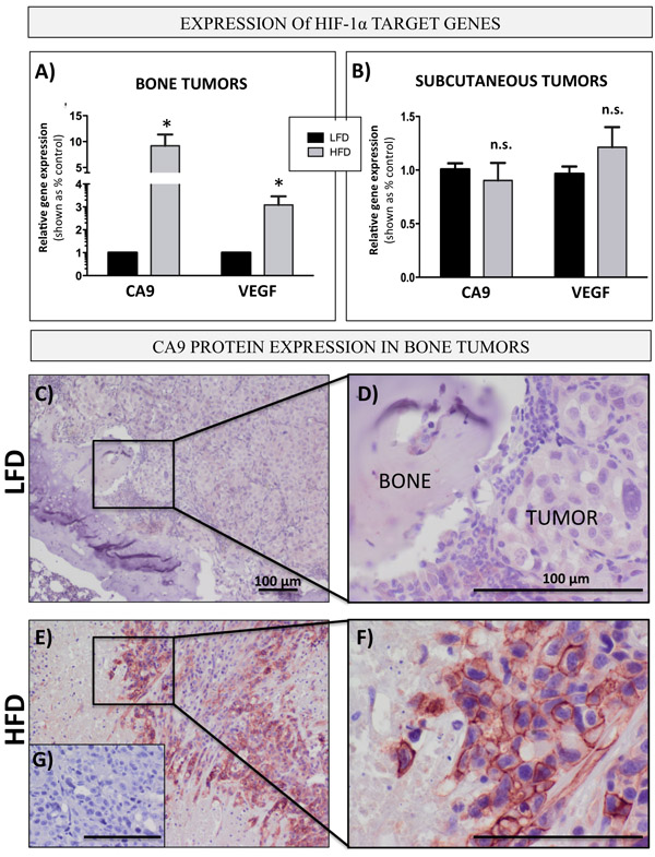 Bone marrow adiposity enhances HIF-1&#x3b1; signaling in PCa cells