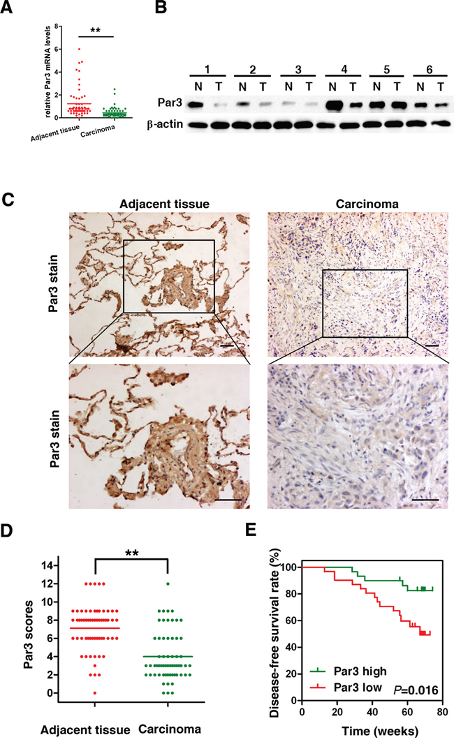 Par3 expression is frequently lost in human LuAC.