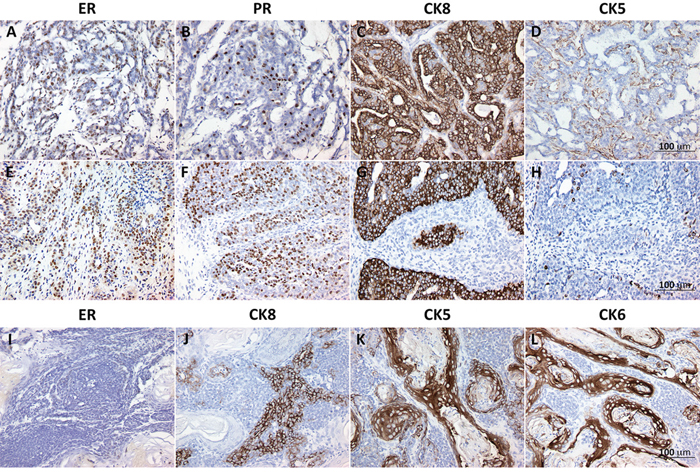 Representative validation of estrogen receptor alpha (ER), progesterone receptor (PR) and luminal and basal cytokeratins (CKs) in mouse mammary tumors.