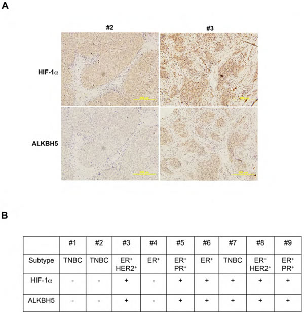 Immunohistochemical analysis of human breast cancer biopsies.