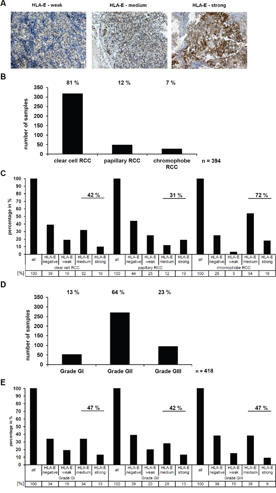 Determination and correlation of the HLA-E expression in RCC tumors (in vivo) with clinical parameters.