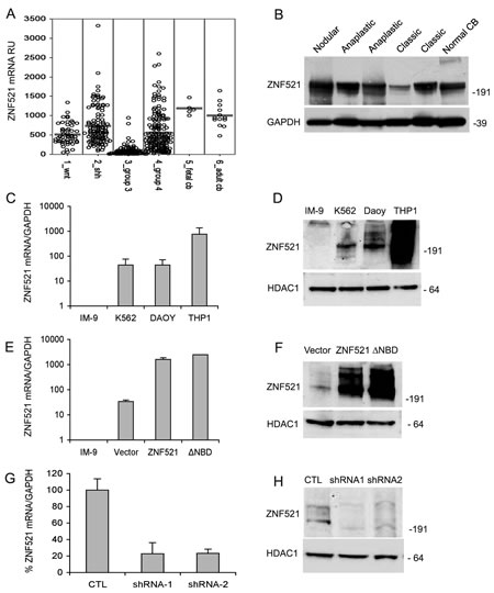 Expression of ZNF521 in human medulloblastomas and modulation of its expression of in DAOY medulloblastoma cells.