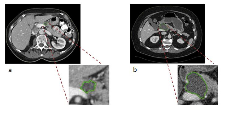 Semi-automated segmentation of two IPMN patient CT scans at the selected central slice.
