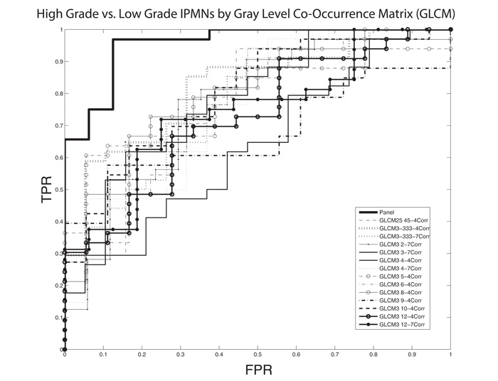 Receiver operating characteristic (ROC) curves demonstrating that pathologically-confirmed, high grade IPMNs are differentiated from low grade IPMNs based on quantitative imaging characteristics generated from a Gray Level Co-Occurrence Matrix (GLCM).