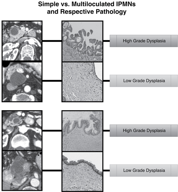 Imaging and respective pathology of several IPMN samples in this study are presented.