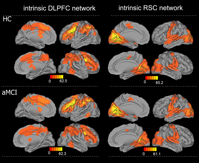 Patterns of intrinsic functional connectivity in the DLPFC and RSC networks in the aMCI and HC groups.