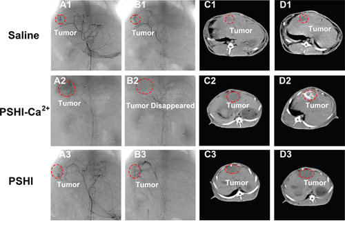 DSA images of VX2 liver tumors in rabbits after embolization with saline (B1), PSHI-Ca2+ (B2) and PSHI (B3), A1, A2 and A3 are DSA images before embolization.