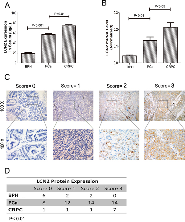 LCN2 expression was upregulated in human PCa tissues.