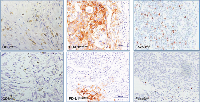 Immunohistochemical staining for immune markers in NSCLC cells (400x).
