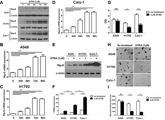 ATRA upregulates Rig-G expression and inhibits the growth of lung cancer cells in vitro.