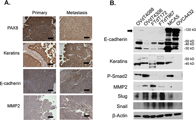 The Dicer-Pten DKO mouse tumor cells express a mixture of epithelial and mesenchymal markers.