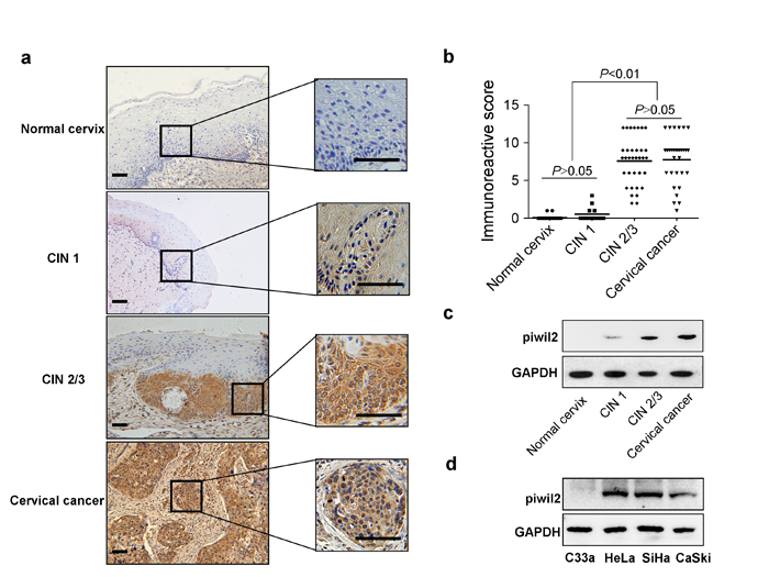 Characteristic Piwil2 expression in cervical cancer and its precursor stages.