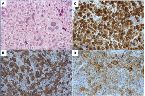 Histological features of mast cells in mast cell sarcoma.