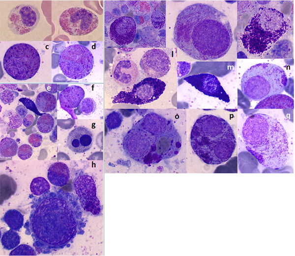 Cytological features from a single case of mast cell sarcoma.