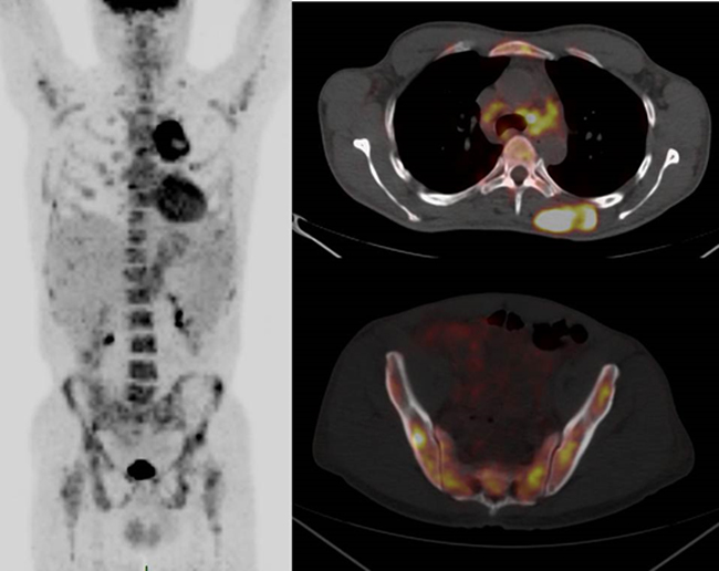 FDG-PET/CT in mast cell sarcoma.