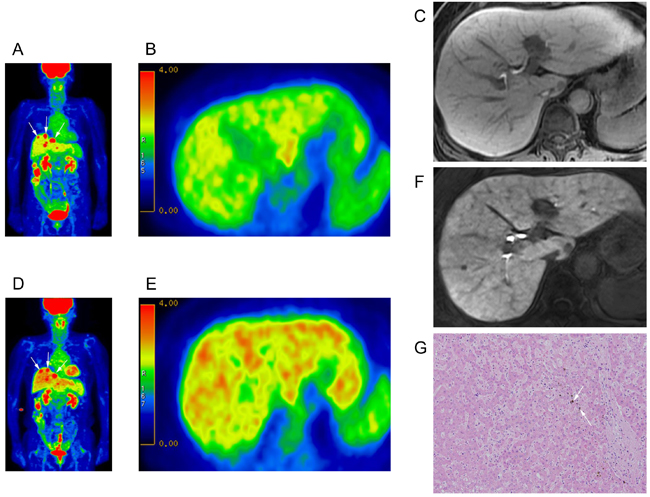 Intensified FDG uptake in patient developing SOS.