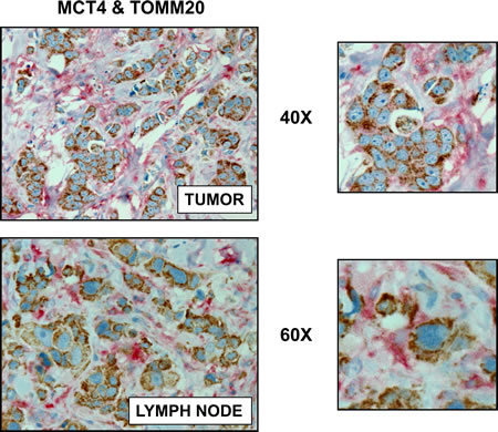 Visualizing Two-Compartment Tumor Metabolism, with Metabolic Marker Proteins: MCT4 and TOMM20.