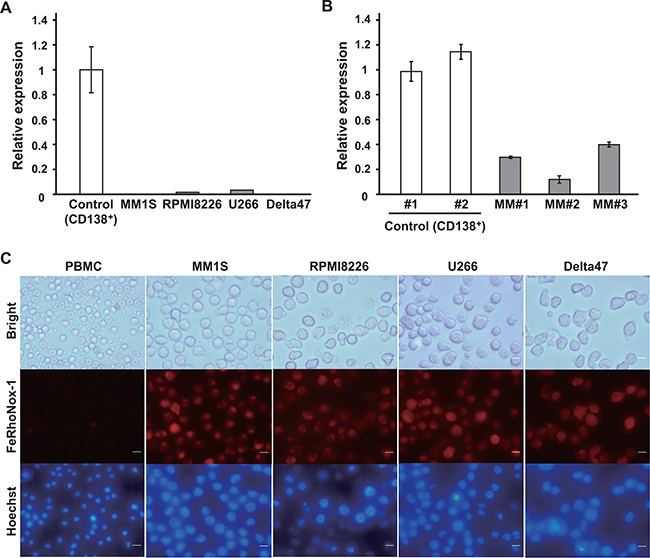 Decreased ferroportin expression and intracellular iron accumulation in MM cells.