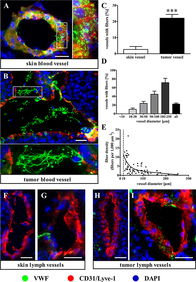 Immunofluorescence staining shows intraluminal VWF fiber formation in the tumor blood vessels of intradermal melanoma tissue.