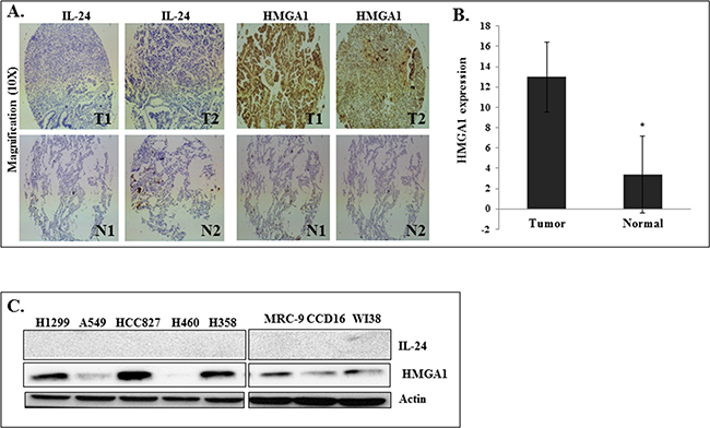 HMGA1 and IL-24 expression in human primary lung tumors and in cultured human lung cancer cells.