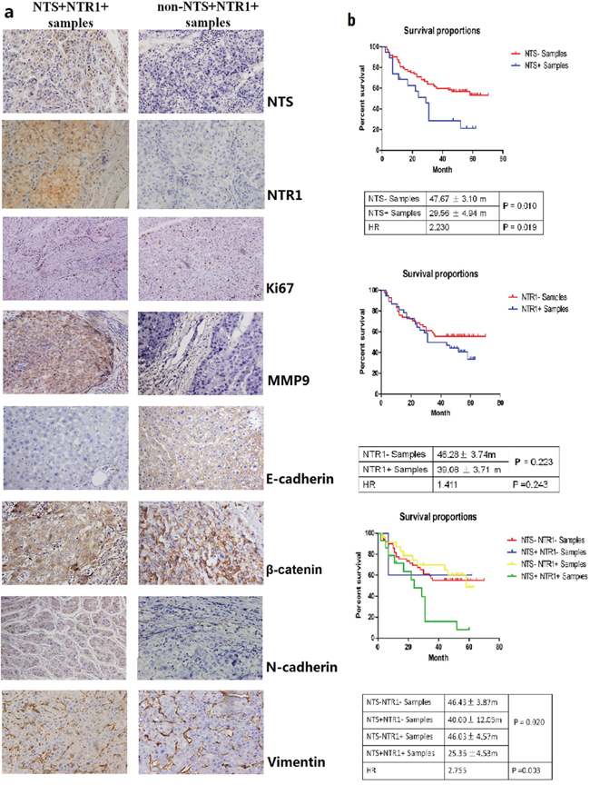 NTS/NTR1 co-expression was correlated with aggressive phenotype and poor clinical outcome of HCC.