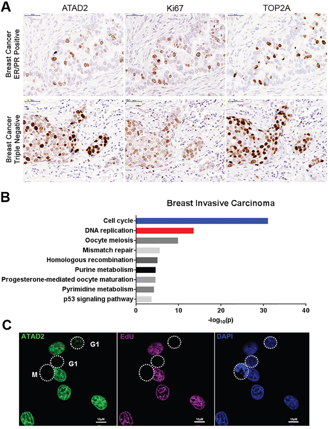 Expression of ATAD2 in primary tumors and MCF7 breast cancer cells.