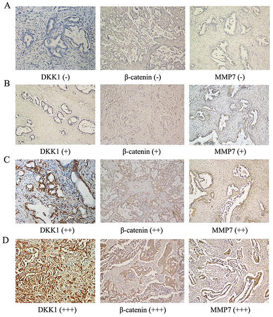 Expression of DKK1, &#x03B2;-catenin and MMP-7 in human HCCA tissues.