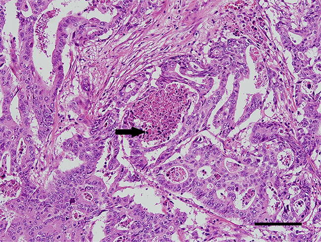 A representative immunohistochemistry image of POLE-mutated colorectal cancer.