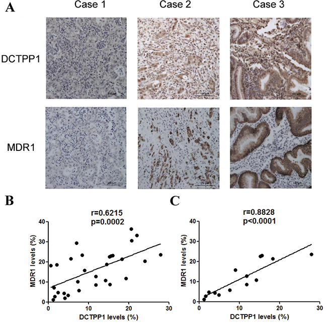 Correlation analysis of DCTPP1 and MDR1 expression in gastric cancer tissues.