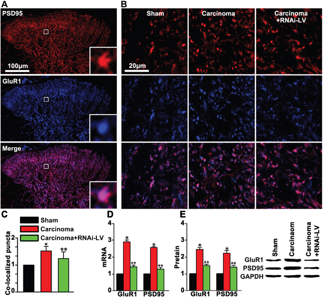 GPR30 up-regulated GluR1 and PSD95 in the dorsal horn of cancer-bearing rats.