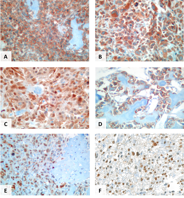 immunostaining patterns with YAP/TAZ and &#x3b2;1-integrin in primary or metastatic conventional osteosarcomas.