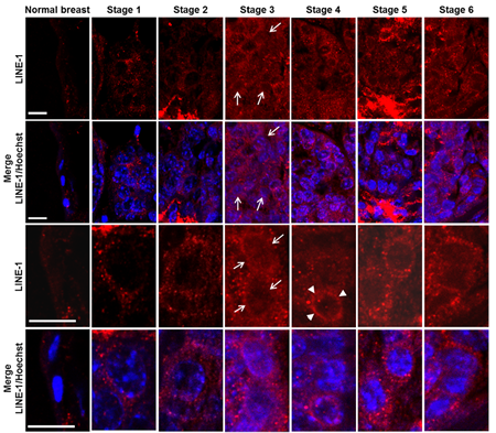 Confocal microscopy of ORF2p intracellular distribution during murine mammary cancer progression.