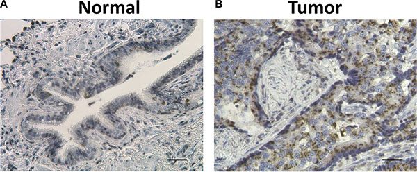 Representative hematoxylin (HE) and ZIP4 IHC staining in surrounding normal tissues (A) and lung cancer tissues (B).
