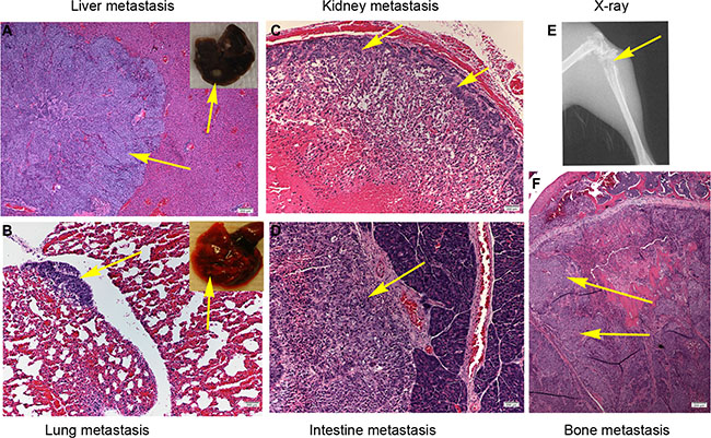 IGFBP6 knockdown in CNE2 cells enhances multiple distant organ metastases in mice.