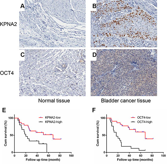 KPNA2 and OCT4 are up-regulated in bladder cancer tissues and its association with prognosis.