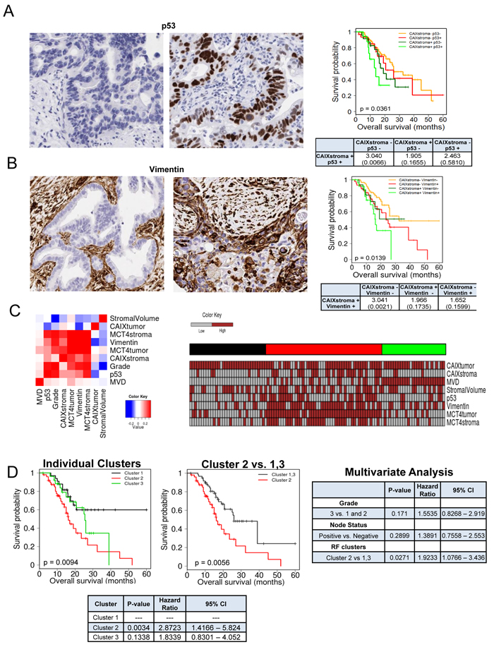 Subtypes of PDAC stroma are associated with distinct tumor features to delineate prognosis.