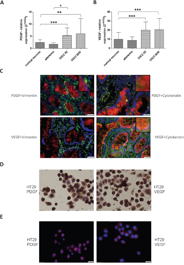 PDGF and VEGF expression in human colon cancer probes and in HT29 cell line.