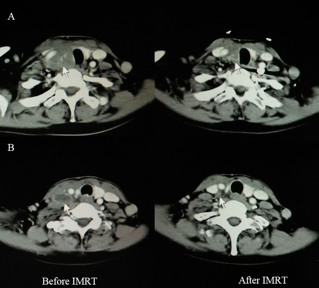 Computed tomography findings before (left) and after (right) IMRT for one patient with CASTLE who received palliative resection.