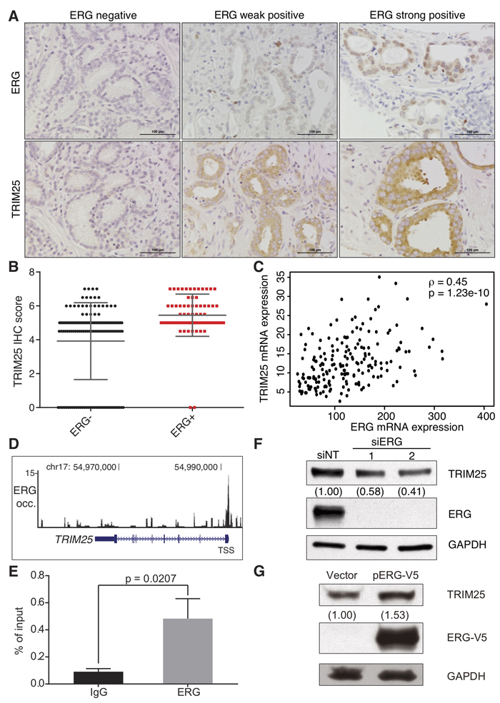 ERG is a positive transcriptional regulator of TRIM25 expression in prostate cancer.