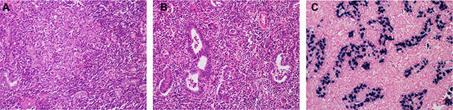 Histological features of lymphoepithelioma-like cholangiocarcinoma.